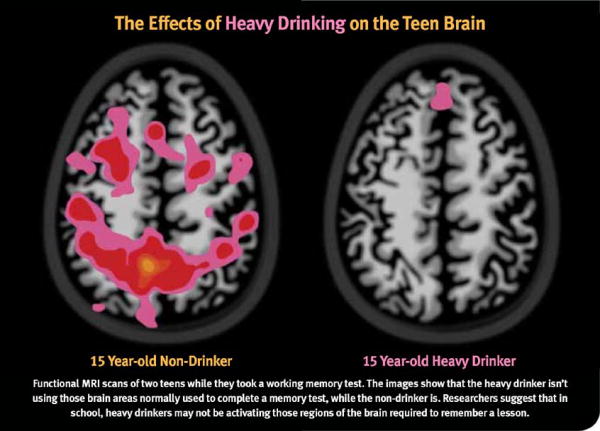 Underage Drinking and the Teen Brain